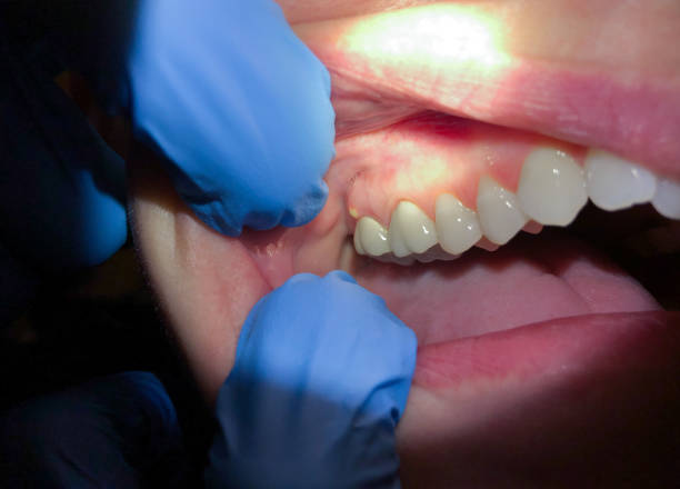 Best Chipped Tooth Repair Near Me  in Winchester, IL